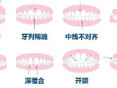 牙齿矫正了半年，为什么还没变化？