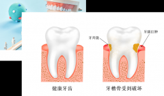 【科普】|什么是龈下刮治？