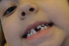 孩子乳牙滞留拔牙好吗？