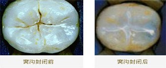 窝沟封闭效果
