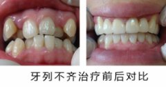 牙长歪了怎么办?