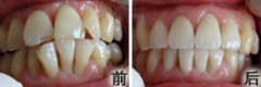 牙齿拥挤怎么矫正效果好