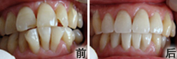 牙齿拥挤怎么矫正效果好