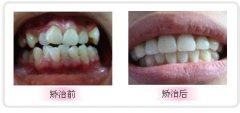 牙齿拥挤可以做美容修复吗