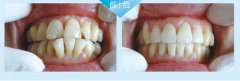 福州牙齿拥挤矫正需要拔牙吗