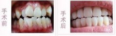 老鼠牙有什么坏处