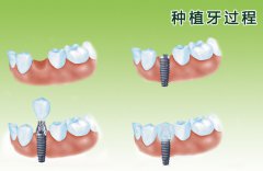 牙齿缺失后什么时候修复比较好