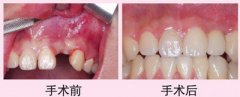 前牙缺失后如何修复？
