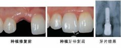 单颗牙齿缺失有什么影响？