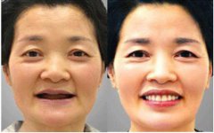 全口牙齿缺失有什么危害吗？