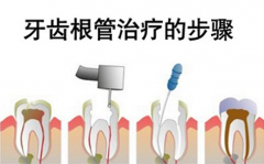 根管治疗