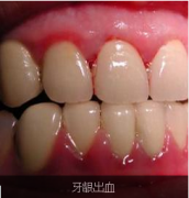 牙龈出血