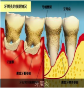 牙周炎