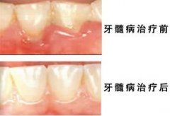 治疗牙髓炎需要多少钱