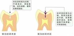 福州做窝沟封闭有副作用吗？