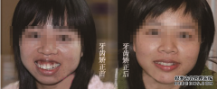 德尔“百万美牙援助基金”掀起暑期学生矫牙热