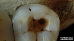 1.4万年前牙齿展示最古老牙科治疗方法 - 超疼(图