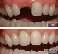 前牙缺失有什么危害