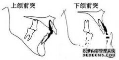 牙齿外突的原因是什么？