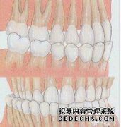 地包天是否存在遗传因素？