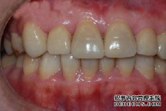 四环素牙，造成人们的困扰