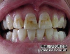 摆脱困扰人们的色素牙