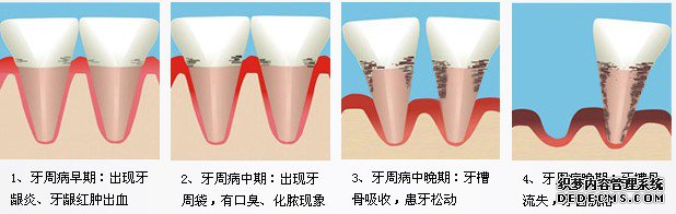 牙周病发展过程
