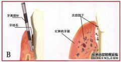 牙龈炎到底是怎么一回事?