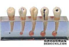 牙髓炎的形成原因有哪些