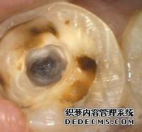 牙髓炎常见的原因有哪些