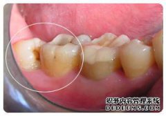 智齿横着长会造成哪些危害