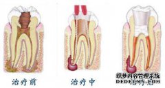 根管治疗拥有哪些过程？