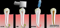 根管治疗后疼痛怎么办