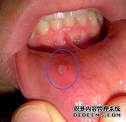 牙博士口腔口腔溃疡