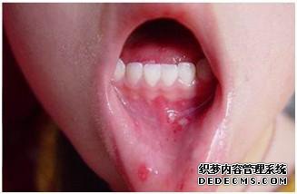 牙博士口腔口腔溃疡