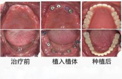 全口牙齿缺失可以植牙吗？