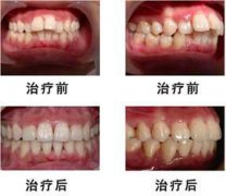 龅牙矫正效果好吗？