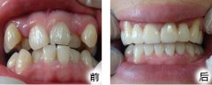 牙列拥挤吃什么好
