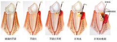 牙髓炎做根管治疗多少钱？