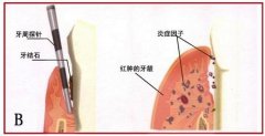 牙龈炎到底是怎么一回事?