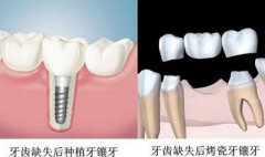 牙齿缺失患者该怎么修复牙齿