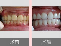 洗牙能去掉烟渍牙吗