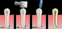 什么是牙齿根管治疗