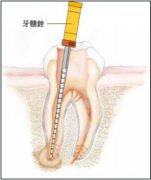 根管治疗了要做牙冠吗