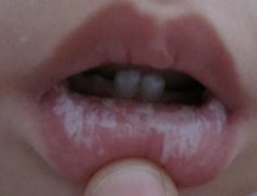 孩子有口腔溃疡要怎么办