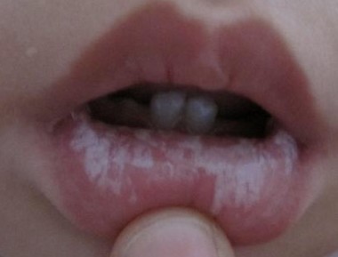孩子有口腔溃疡要怎么办