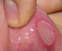 口腔溃疡是由哪些原因引起的
