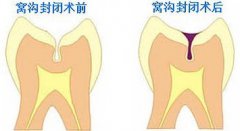 浅谈窝沟封闭的必要性