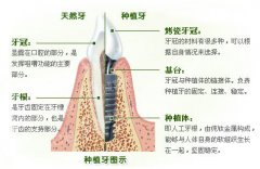 后牙缺失的危害是由哪些