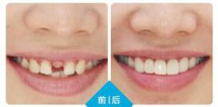 牙齿缺失怎么治